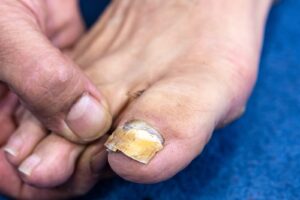 Examen clínico de una uña del pie afectada por onicomicosis